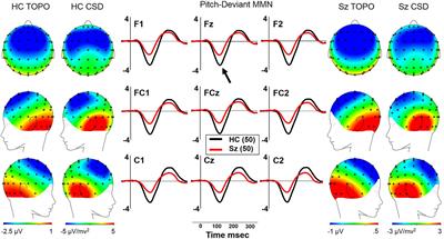 Mismatch Negativity and Impaired Social Functioning in Long-Term and in First Episode Schizophrenia Spectrum Psychosis